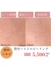 《背中ニキビ・ザラザラ》【背中ハイドロピーリング￥5500】美白&背中美人へ