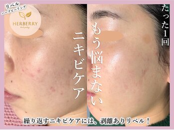 ハーバリー ハーブピーリング 栄(HERBERRYハーブピーリング)/数回でお悩み改善最強ピーリング