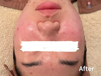 ダイヤモンド リーエンダ(Diamond leende)/クレイハーブピーリング