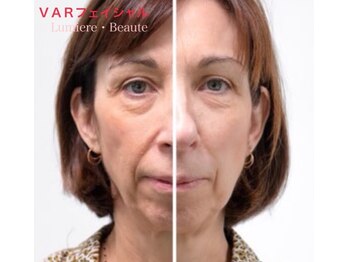 リュミエールボーテ/《NEW！》ＶＡＲフェイシャル