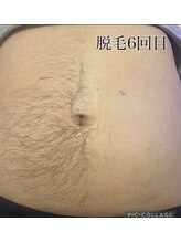 エンカフェサロン(en-cafe salon)/部分脱毛6回目《¥5000》