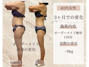 サロン ド ボーテ ラーンジュ 岐阜店(salon de beaut'e L'ange)/ハイパ-ナイフEX2ダイエット痩身