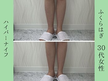 ソルニス(Solnis.)/痩身☆脂肪分解/ハイパーナイフ