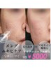 【メンズニキビケア45分】毛穴洗浄+殺菌成分導入¥6000→¥5000
