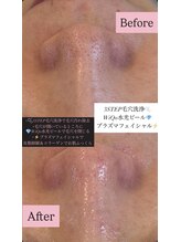 アイリス(AiRiS)/◎黒ずみ/開き毛穴