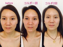 オプレア 千種店(OPREA)/【比較写真】小顔コルギ