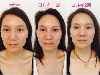 オプレア 千種店(OPREA)/【比較写真】小顔コルギ