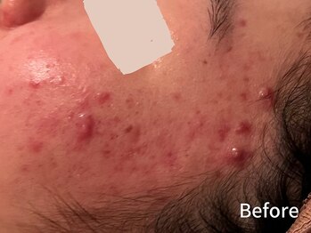 ダイヤモンド リーエンダ(Diamond leende)/クレイハーブピーリング