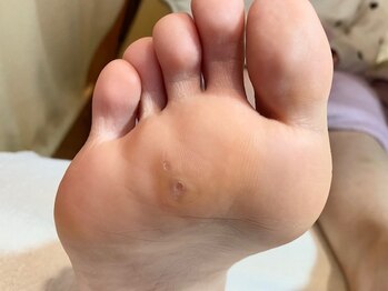 ビサンテ サロン/先進フットケアで魚の目キレイ-7