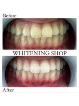 ホワイトニングショップ 明石大久保店/【BeforeAfter】