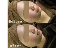 カヨン 新所沢店(KAYON)/赤み対策にはバリア機能強化ケア