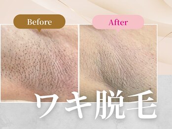 フェルナ 上新庄店(FERNA)/ワキ脱毛