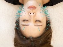 ソセイラボ ウェルネス(SOSEI Lab. wellness)の雰囲気（モデルや女優さんも受けられてる美容鍼！）