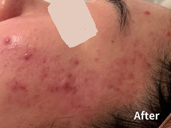 ダイヤモンド リーエンダ(Diamond leende)/クレイハーブピーリング