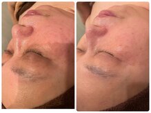 クイーンズ ピュア 長崎店(Queen's Pure)/ 水光エアートリートメント