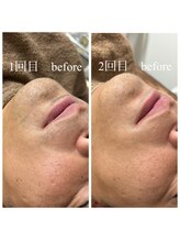 ランプ(LAMP)/～ハイブリッドヒゲ脱毛～