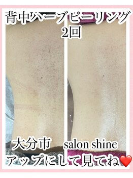 サロンシャイン(Salon Shine)/背中ハーブピーリング２回