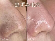 シエナ(ciena)/水素水毛穴洗浄症例写真♪