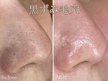 シエナ(ciena)/水素水毛穴洗浄症例写真♪