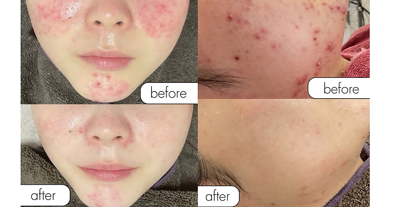 ニキビケア研究所 本厚木店｜ホットペッパービューティー