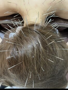 アイリス鍼灸マッサージ 上野院(Iris鍼灸マッサージ)の写真/【どこに行っても改善しない…と諦めていたそこのあなた！】当店の《ルート鍼》を試してみませんか？