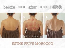エステプリヴェモロッコ(ESTHE PRIVE MOROCCO)