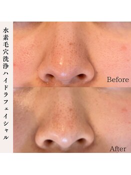 プラウド(Proud)/毛穴洗浄ケア