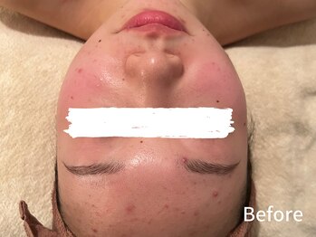 ダイヤモンド リーエンダ(Diamond leende)/クレイハーブピーリング