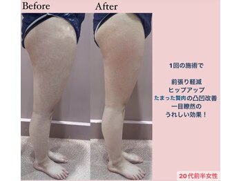 じぶんdeエステ 梅田店/CELLZERO.式 症例/太もも/1回