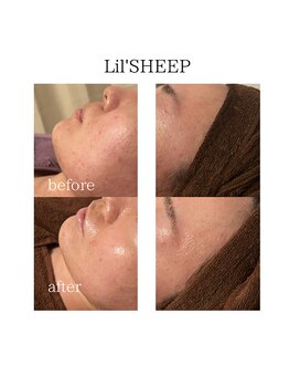 リルシープ(LIL'SHEEP)/ハーブピーリング