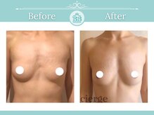美人バスト 福岡店/バストアップ ◇症例◇