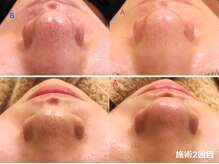 ナチュレアンドメディカ(Nature&Medica)/顔脱毛＋毛穴ケアフェイシャル