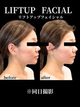 ノーブルノアール(Noble noir)/下顔面リフトアップ♪