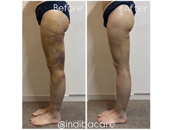 インディバケアプラチナム 恵比寿店/太もも/術/後ケア/アフターケア