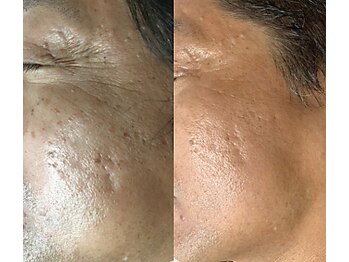 んまち/シミケア