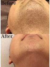 ミランオオサカ(MIRAN OSAKA)/ヒゲ メンズ脱毛 大阪