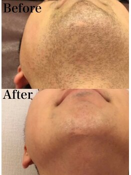 ミランオオサカ(MIRAN OSAKA)/ヒゲ メンズ脱毛 大阪