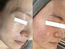 スイ メゾン アトリエ(SUE Maison Atelier)の雰囲気（ハーブピーリング/繰り返す肌悩みにも◯ニキビ.毛穴.くすみ）