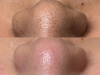 スリーナイン ビュウ(3Nine BEAU)/1回目before/after