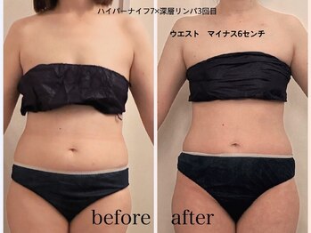 ナースのロミリンパの写真/ハイパーナイフ7と深層リンパ！更に遠赤滝汗サウナでしぼる！続けて感動！サイズダウン！美ボディを目指す
