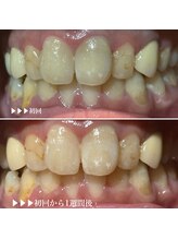 ビーバイビー(BBYB)/ホワイトニングのモニター様♪