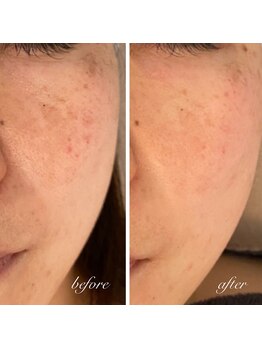 ルミア(Rumia)/BBL♪3回施術のお客様♪