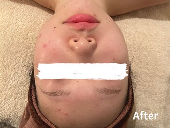 ダイヤモンド リーエンダ(Diamond leende)/クレイハーブピーリング