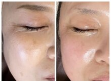 ディサイドロー(DECIDE L.A.W)/BeforeAfter