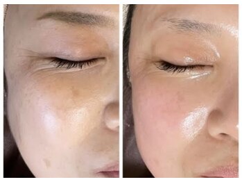 ディサイドロー(DECIDE L.A.W)/BeforeAfter