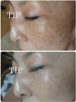 エル(Elle)/【エイジングケア】シミ/くすみ