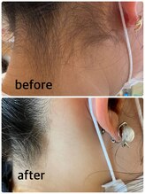 ビーティベーシック(B.t.Basic)/うなじ脱毛