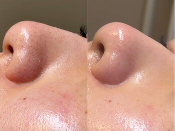 アマト 心斎橋店(Amato)/心斎橋/毛穴洗浄/ワックス脱毛