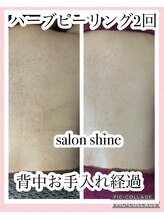 サロンシャイン(Salon Shine)/背中ハーブピーリング２回