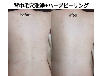 シェリー(Cheri)/【毛穴洗浄+ハーブピーリング】